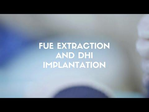 FUE