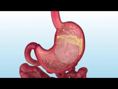 Ballon gastrique 12 mois