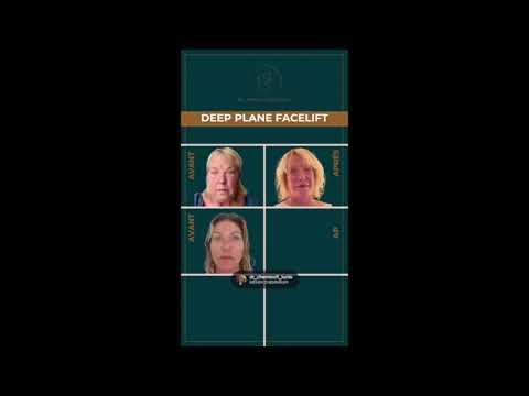 Lifting cervico-facial