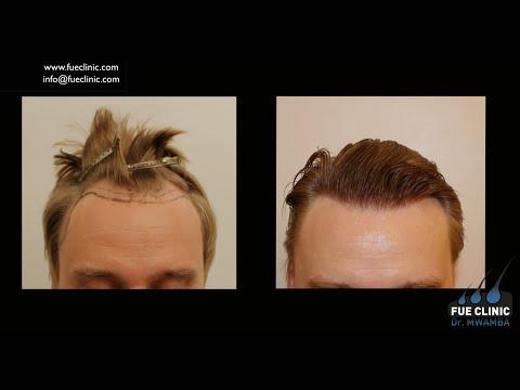 FUE