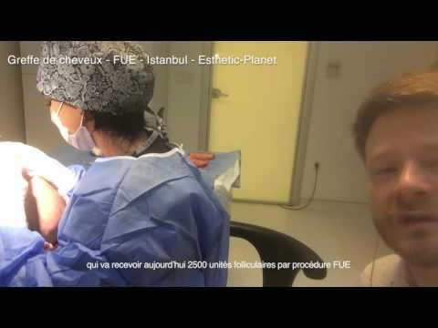 FUE