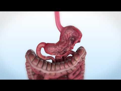 Endo sleeve (plicature)