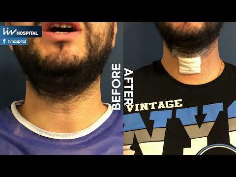 MTF & FTM Cambiamento della voce - Tiroplastica