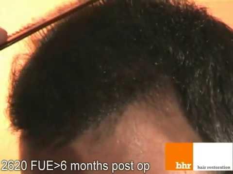 FUE