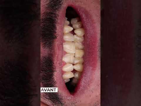 Dental Veneers