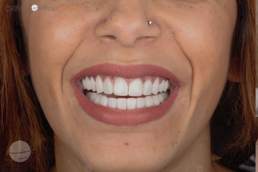 Risultato prima e dopo per Faccette dentali — Dentaglobal