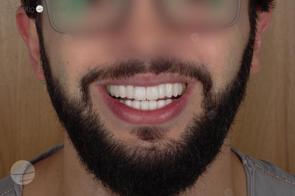 Risultato prima e dopo per Faccette dentali — Dentaglobal