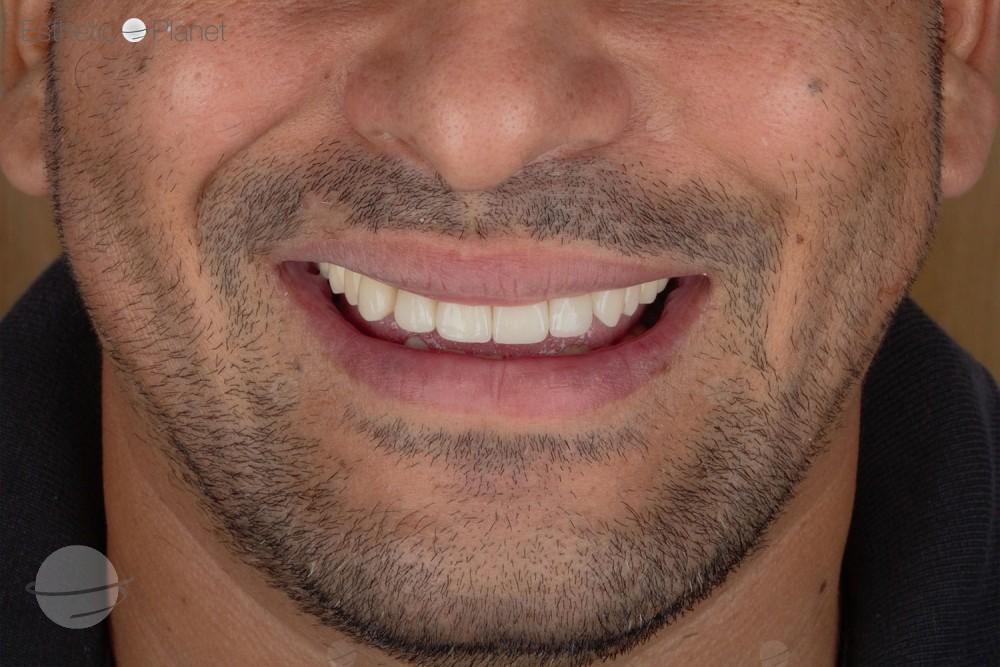 Risultato prima e dopo per Faccette dentali — Dentaglobal