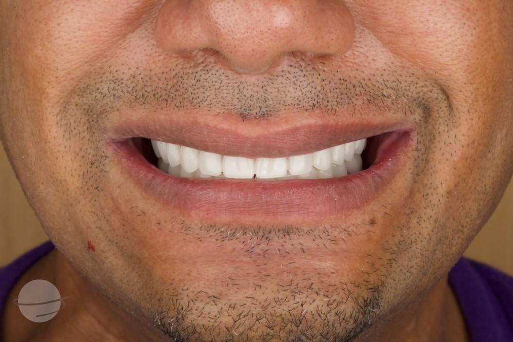 Resultado de antes y después para Coronas dentales — Dentaglobal