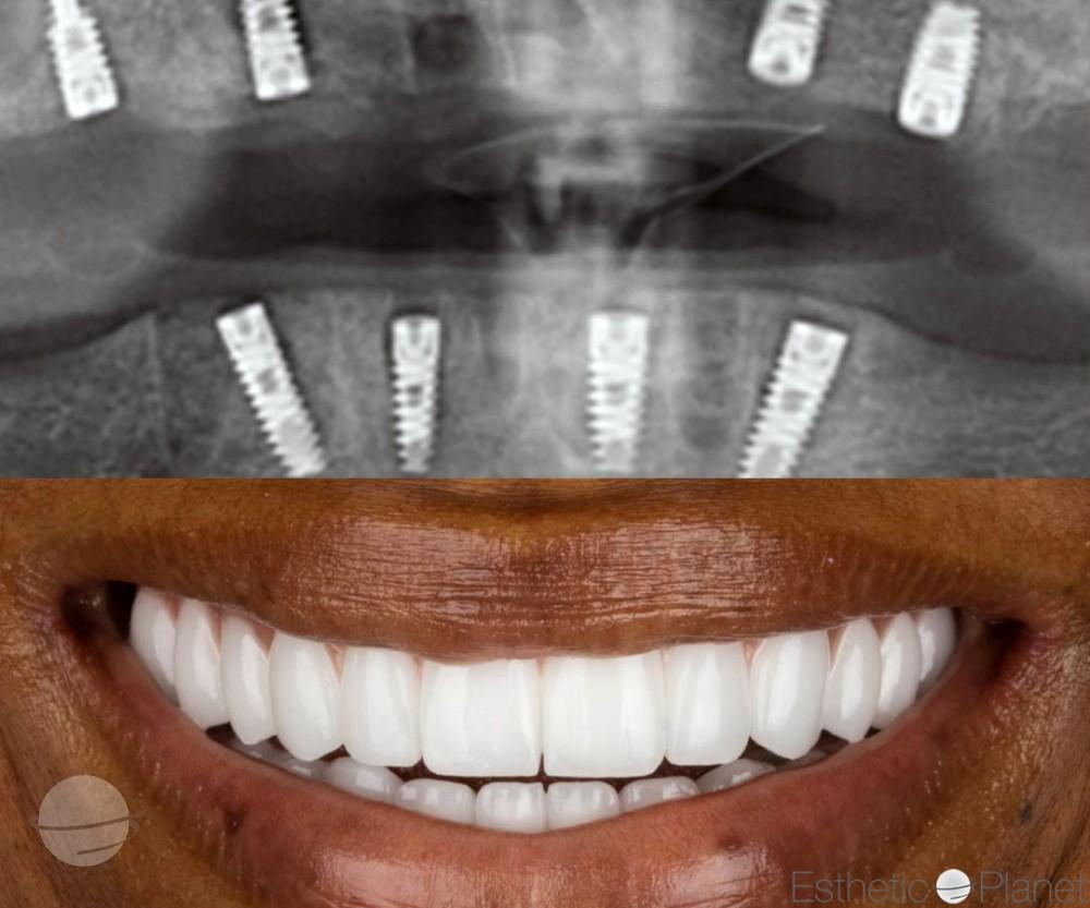 Resultado de antes y después para Coronas dentales — Dentaglobal