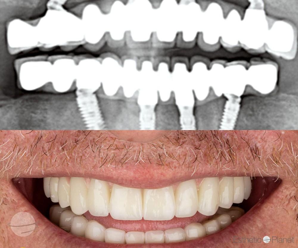 Risultato prima e dopo per Corone dentali — Dentaglobal