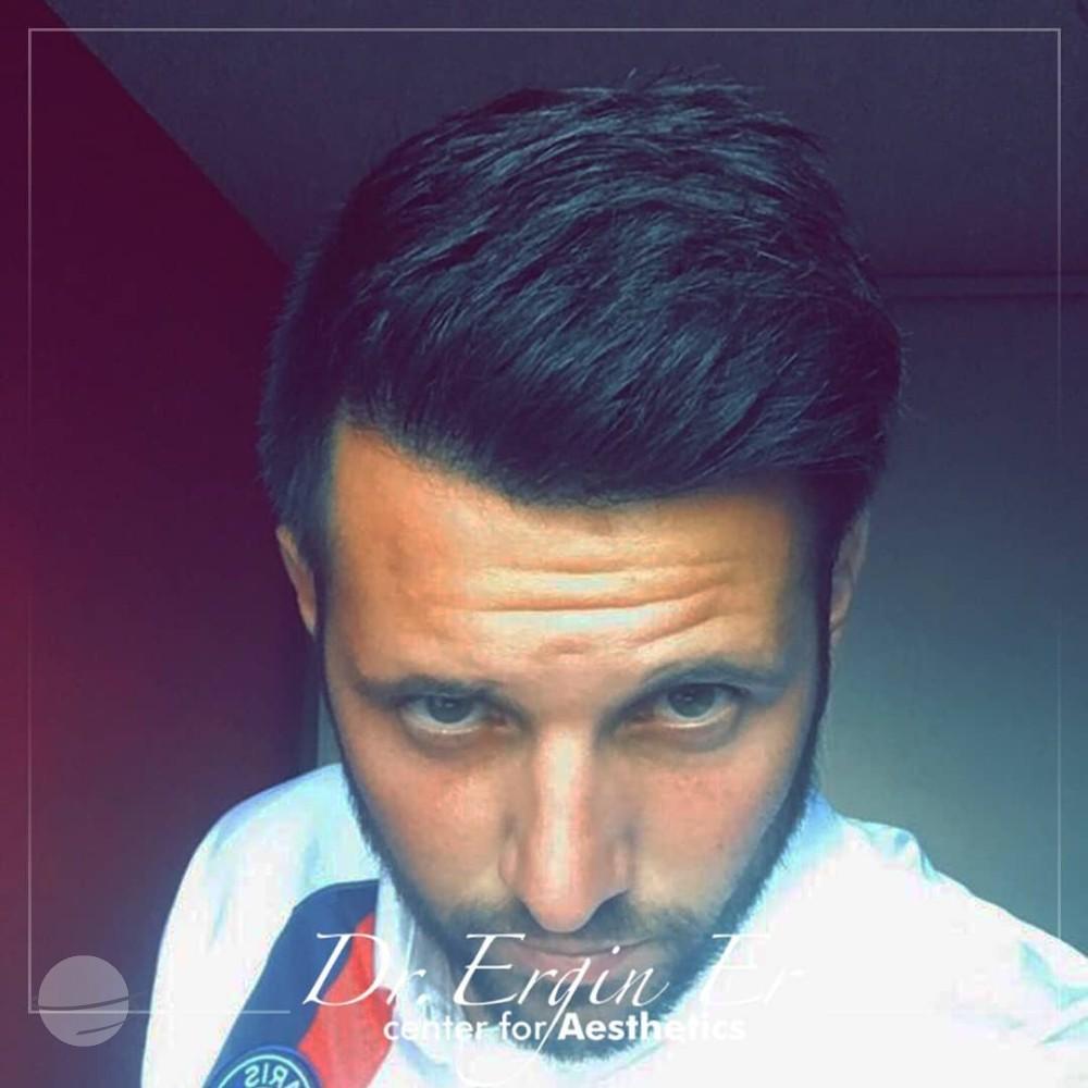 FUE Hair transplant By Esthetic Planet Team