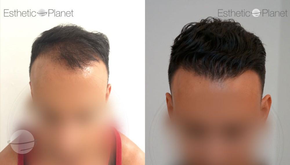 Before and after case 1 