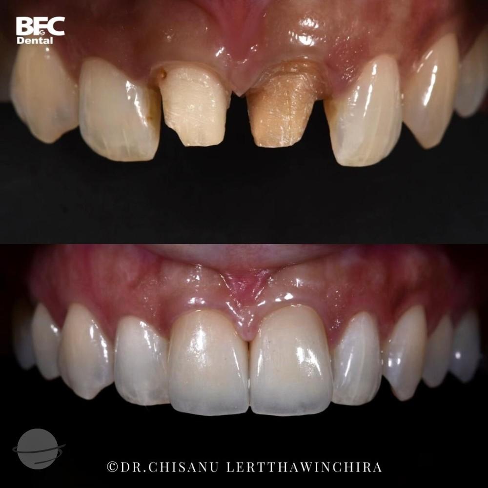 ceramic-veneers-3