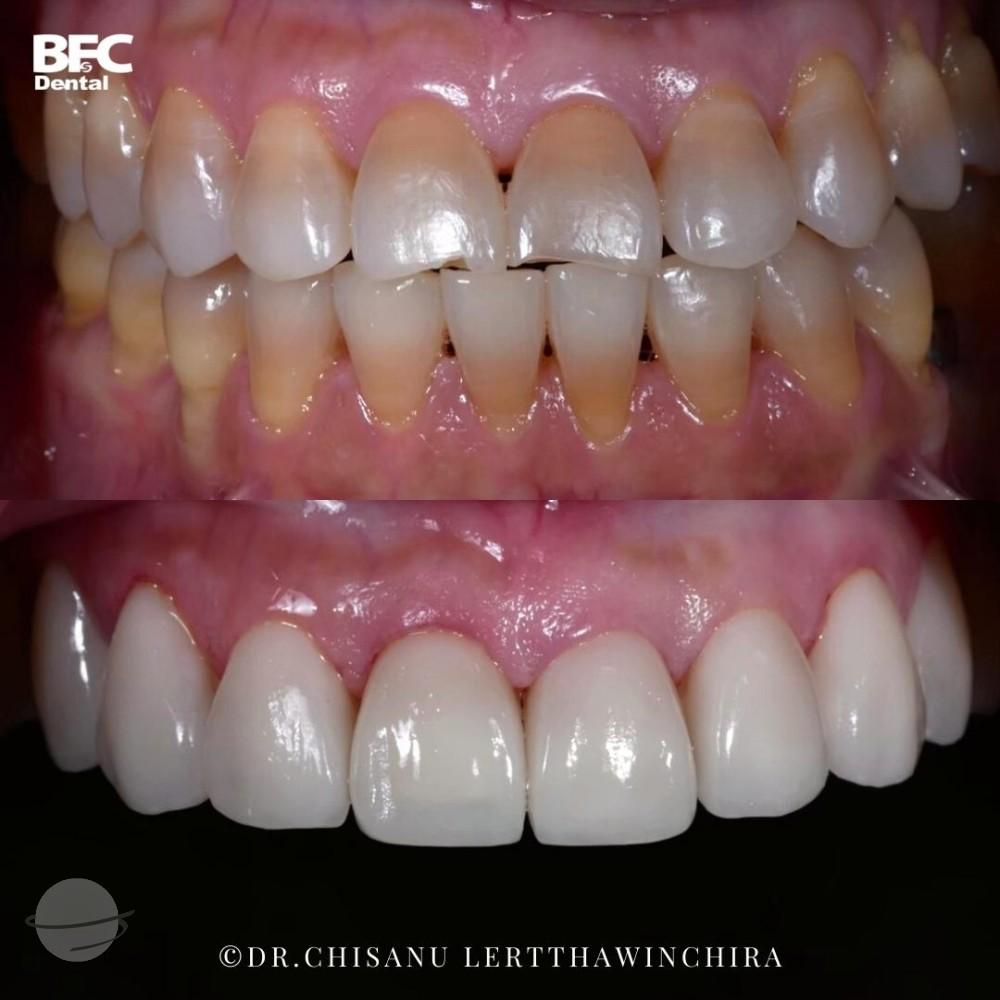 ceramic-veneers-6