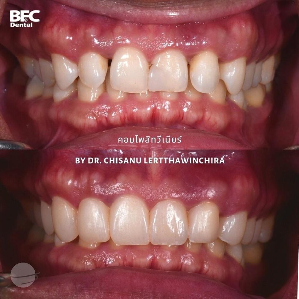 composite-veneers-1