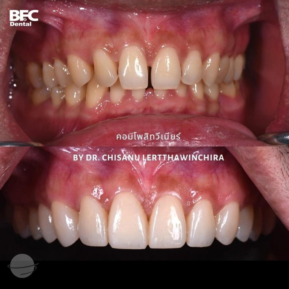 composite-veneers-2