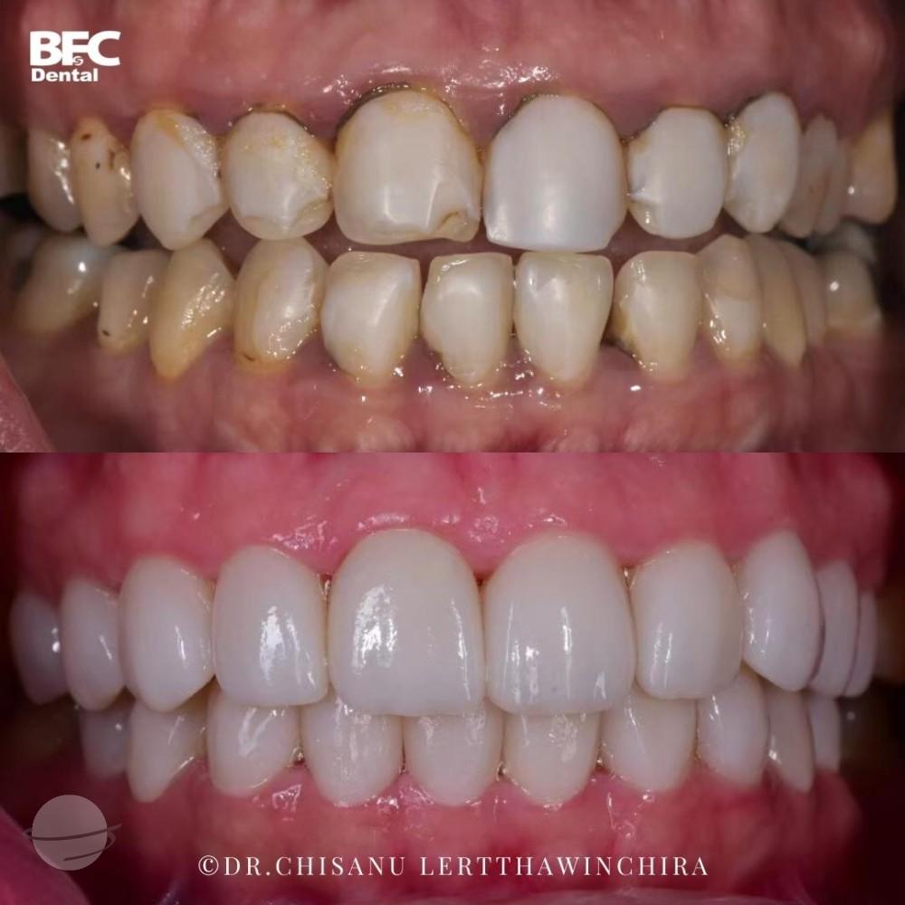 composite-veneers-10