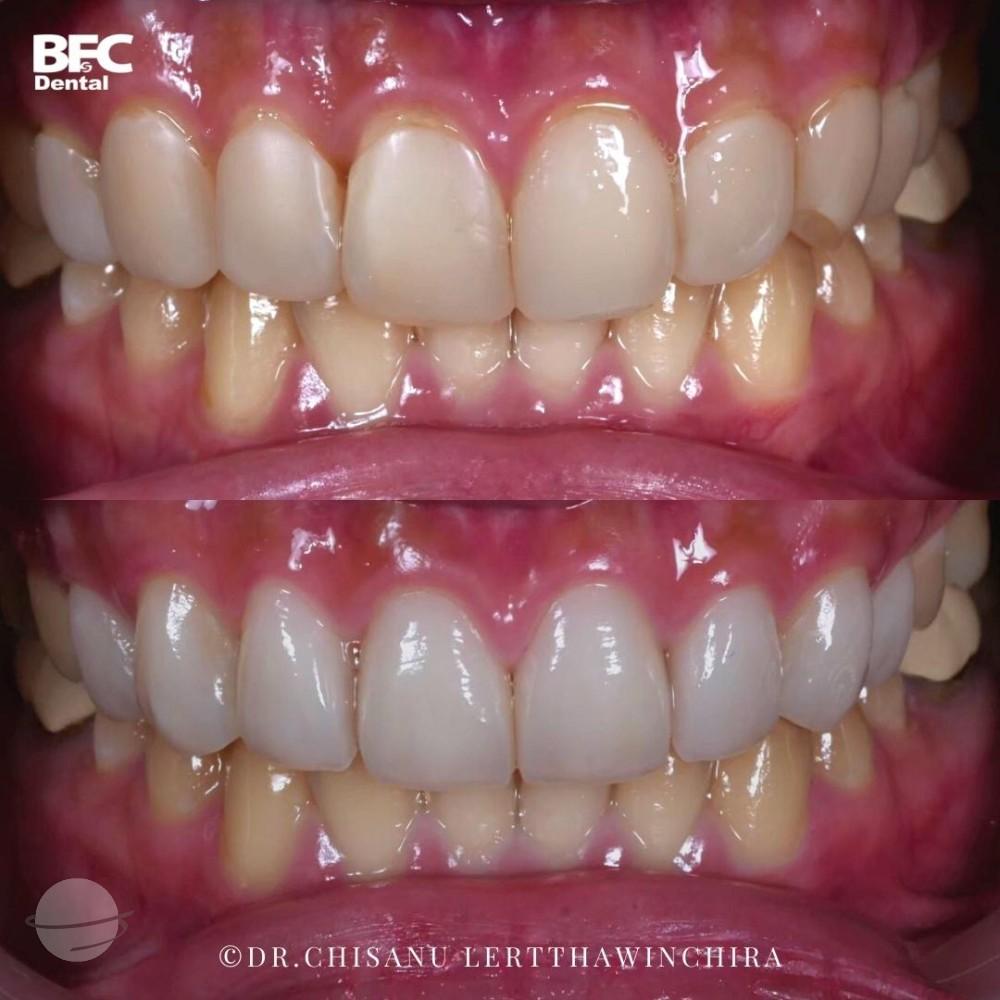 composite-veneers-11