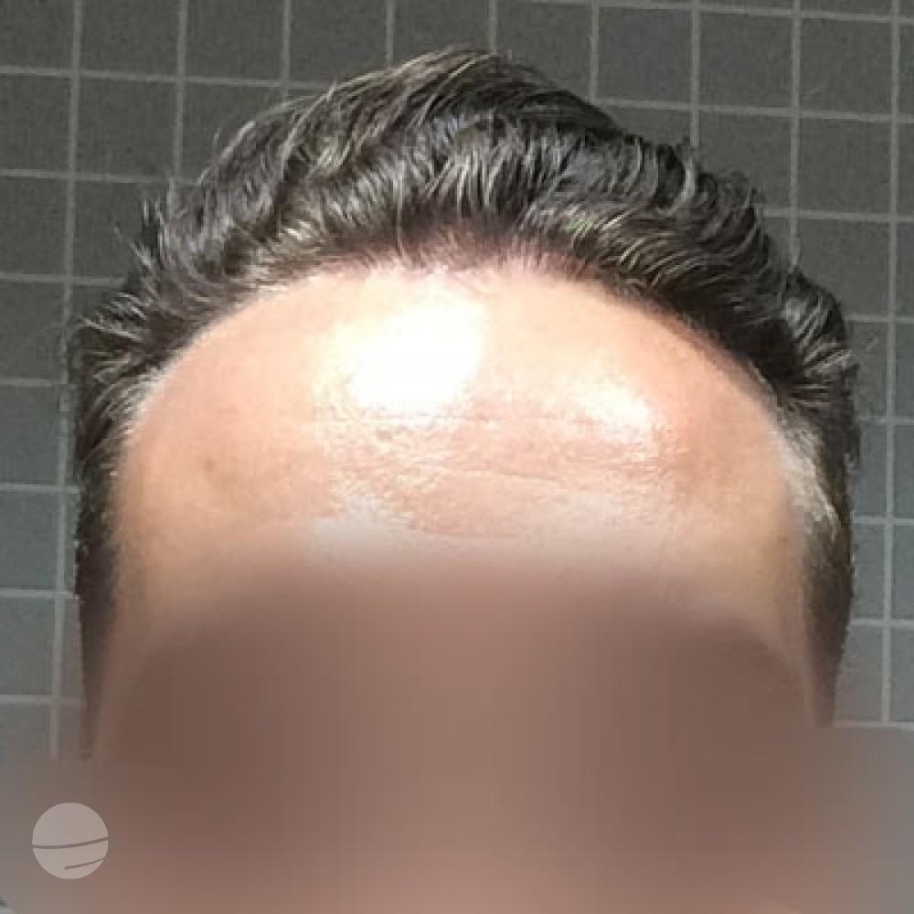 After FUE CASE 2