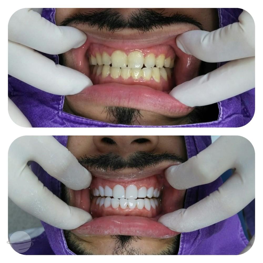 Dent Spa Composite venners