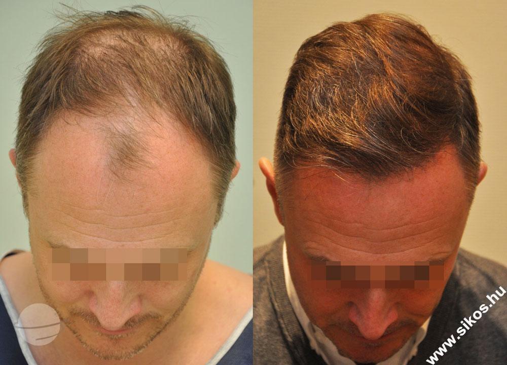 Risultato prima e dopo per FUE — Dr. Sikos Geza Clinic