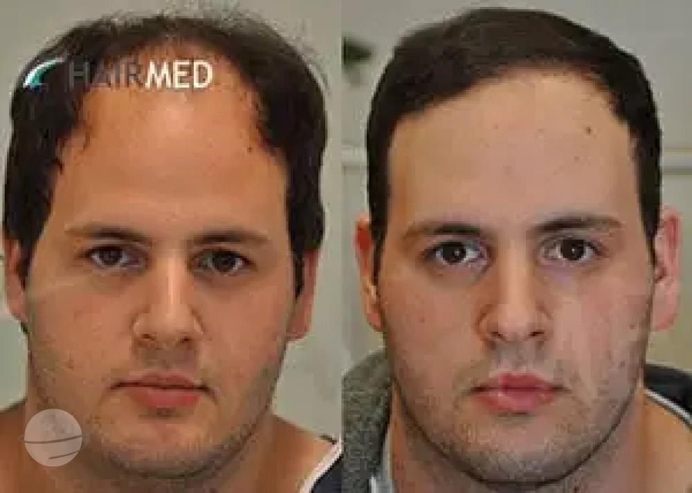 Risultato prima e dopo per FUE — Dr. Sikos Geza Clinic
