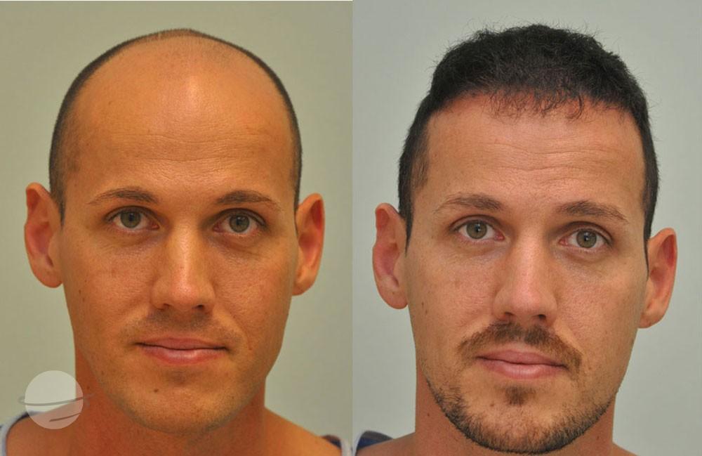 Resultado de antes y después para FUE — Dr. Sikos Geza Clinic