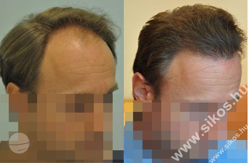 Resultado de antes y después para FUE — Dr. Sikos Geza Clinic