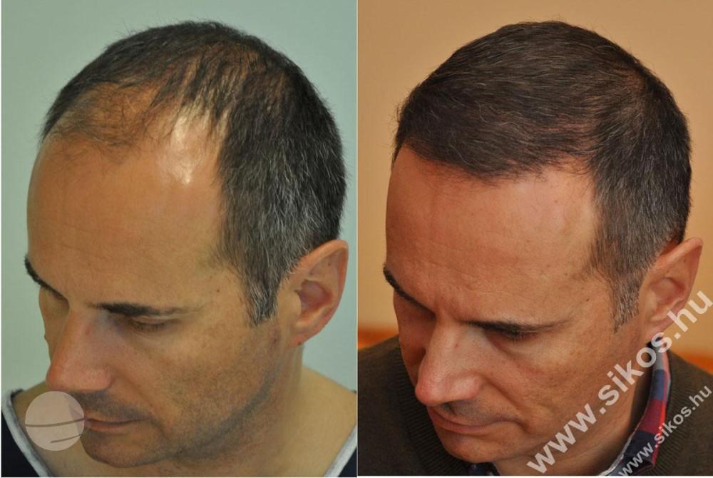 Resultado de antes y después para FUE — Dr. Sikos Geza Clinic