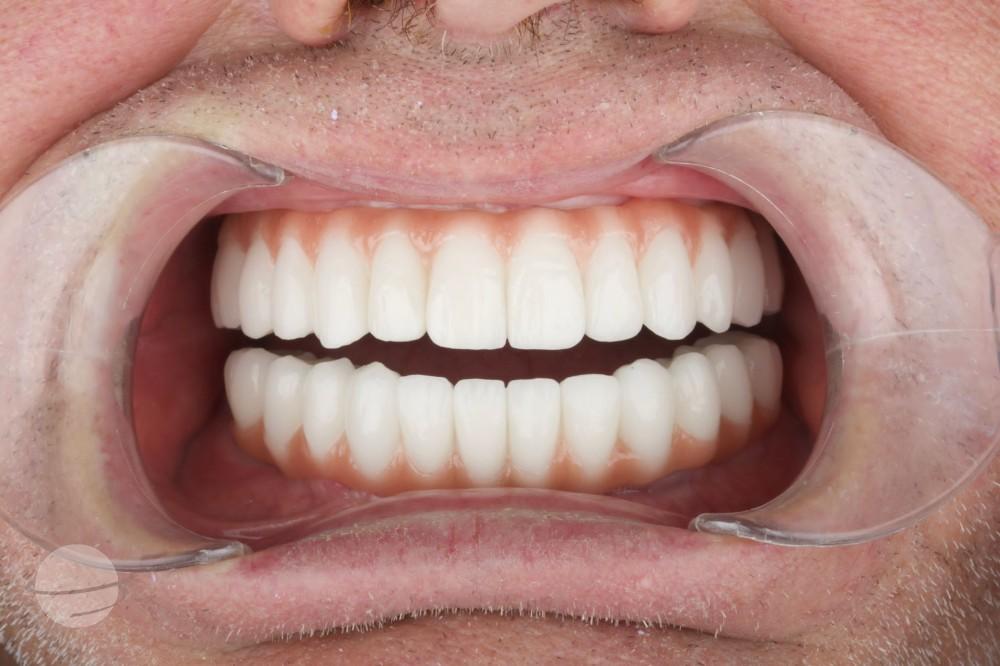Risultato prima e dopo per Impianti dentali — Dentaglobal