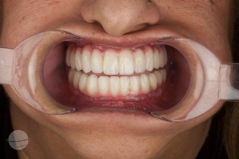 Résultat avant / après pour Implants Dentaires — Dentaglobal