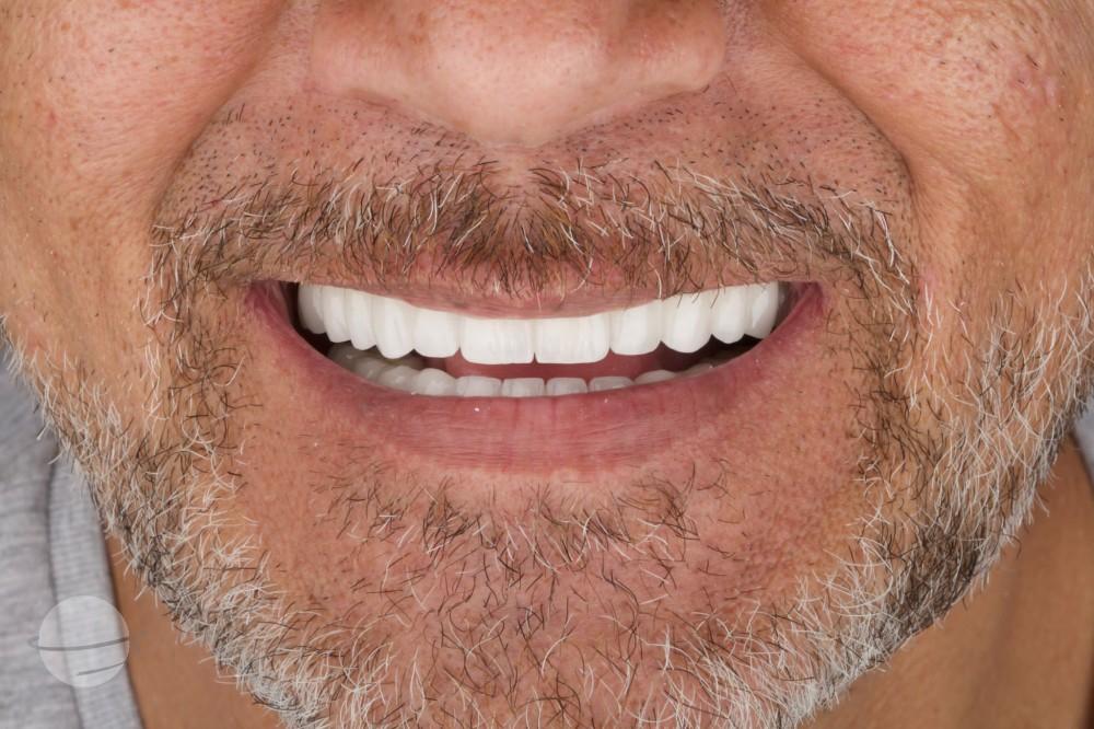 Risultato prima e dopo per Impianti dentali — Dentaglobal