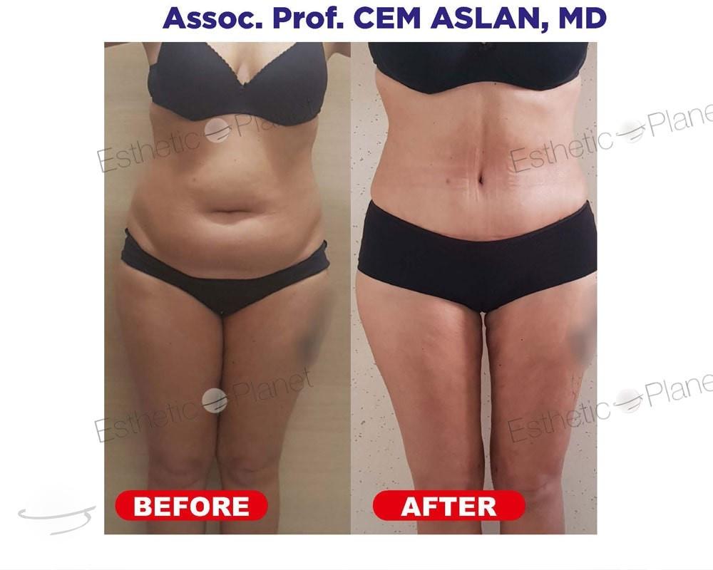 lipo4-min