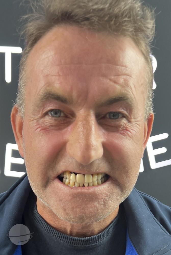 Before and after result for Zirconium crowns — Dentglow