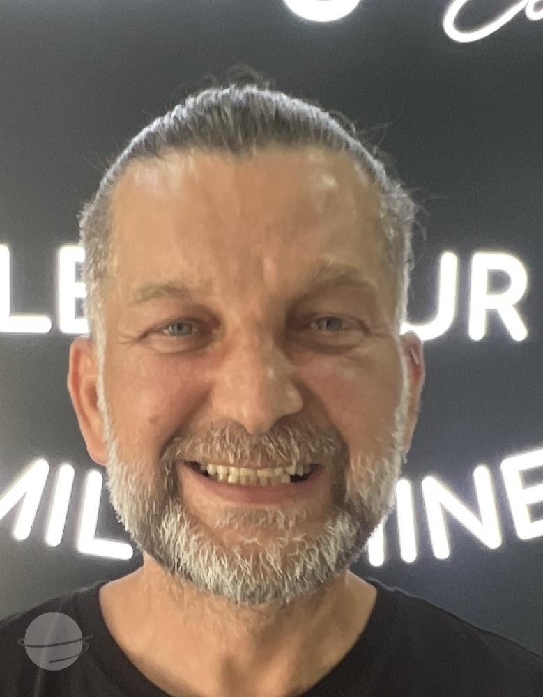 Risultato prima e dopo per Corone zirconio — Dentglow
