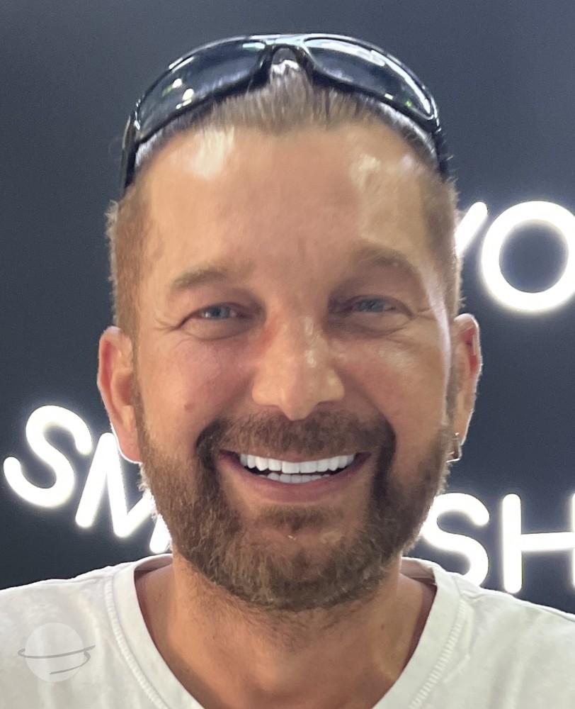 Risultato prima e dopo per Corone zirconio — Dentglow