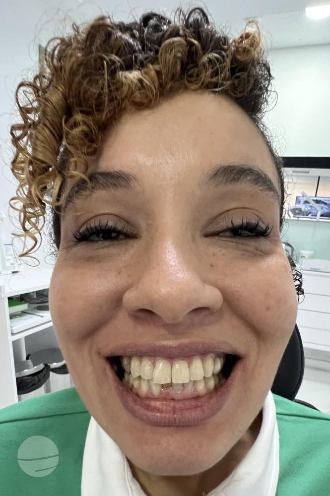 Resultado de antes y después para Coronas de circonita — Dentglow