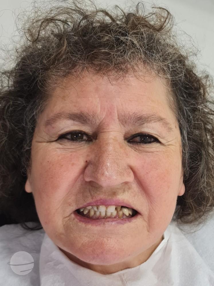 Résultat avant / après pour Couronnes Zircones — Dentglow
