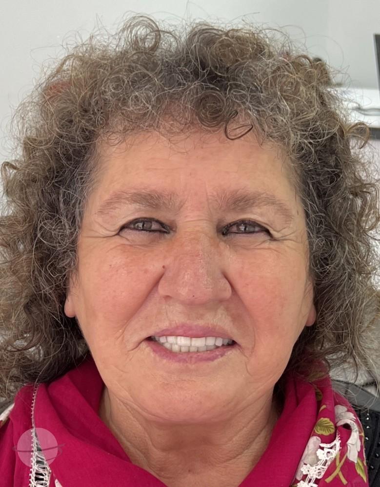Resultado de antes y después para Coronas de circonita — Dentglow