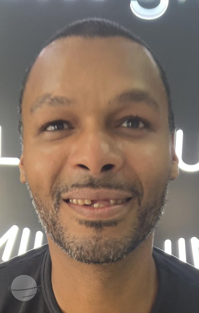 Resultado de antes y después para Coronas de circonita — Dentglow