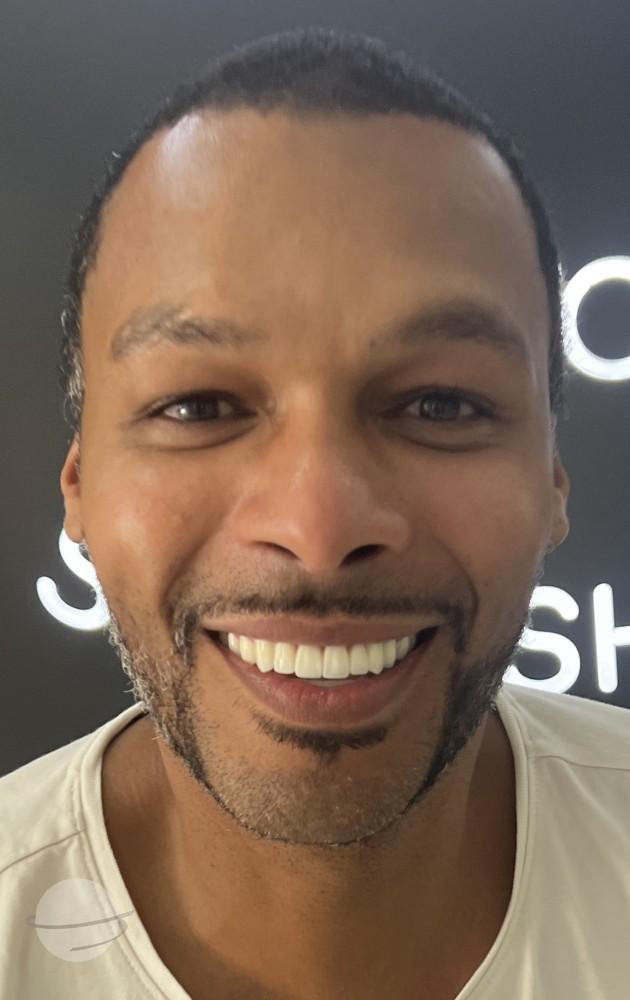 Resultado de antes y después para Coronas de circonita — Dentglow