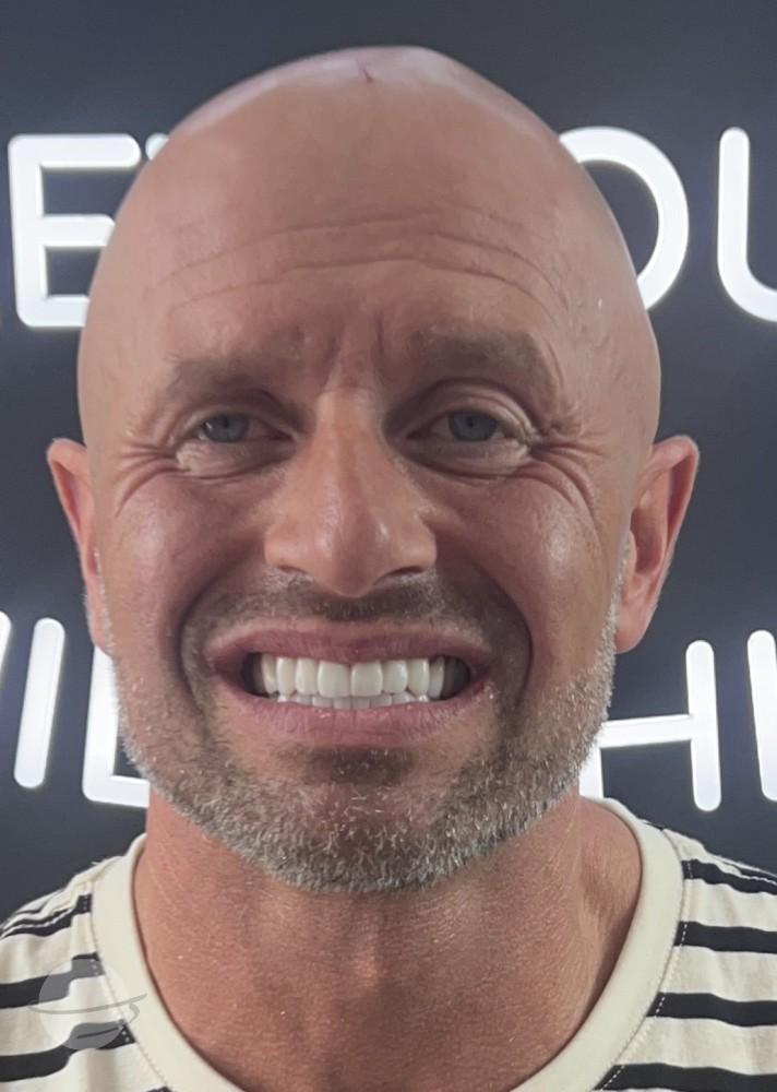 Risultato prima e dopo per Corone zirconio — Dentglow