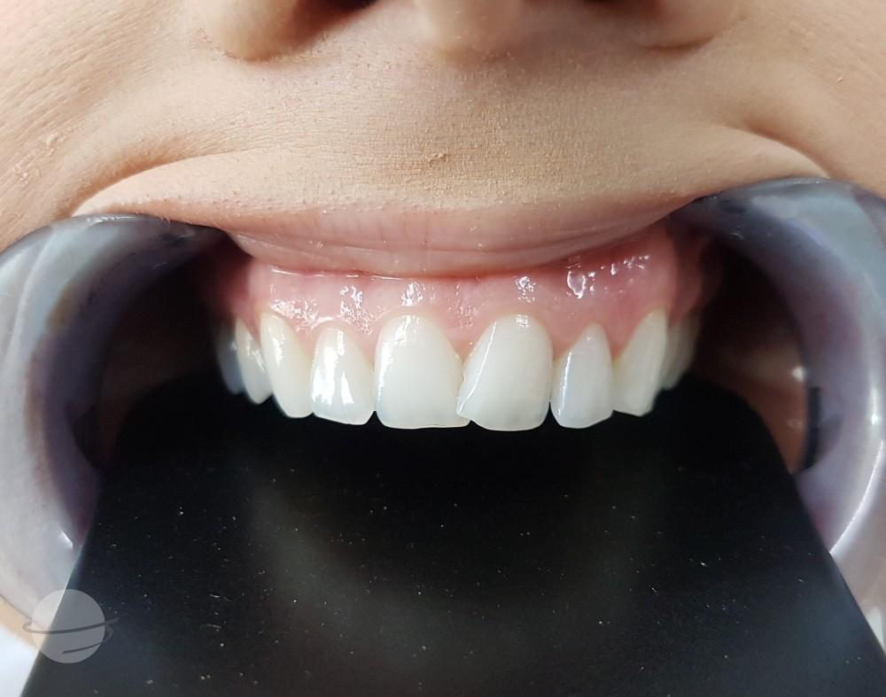 Before Veneers / Avant facettes