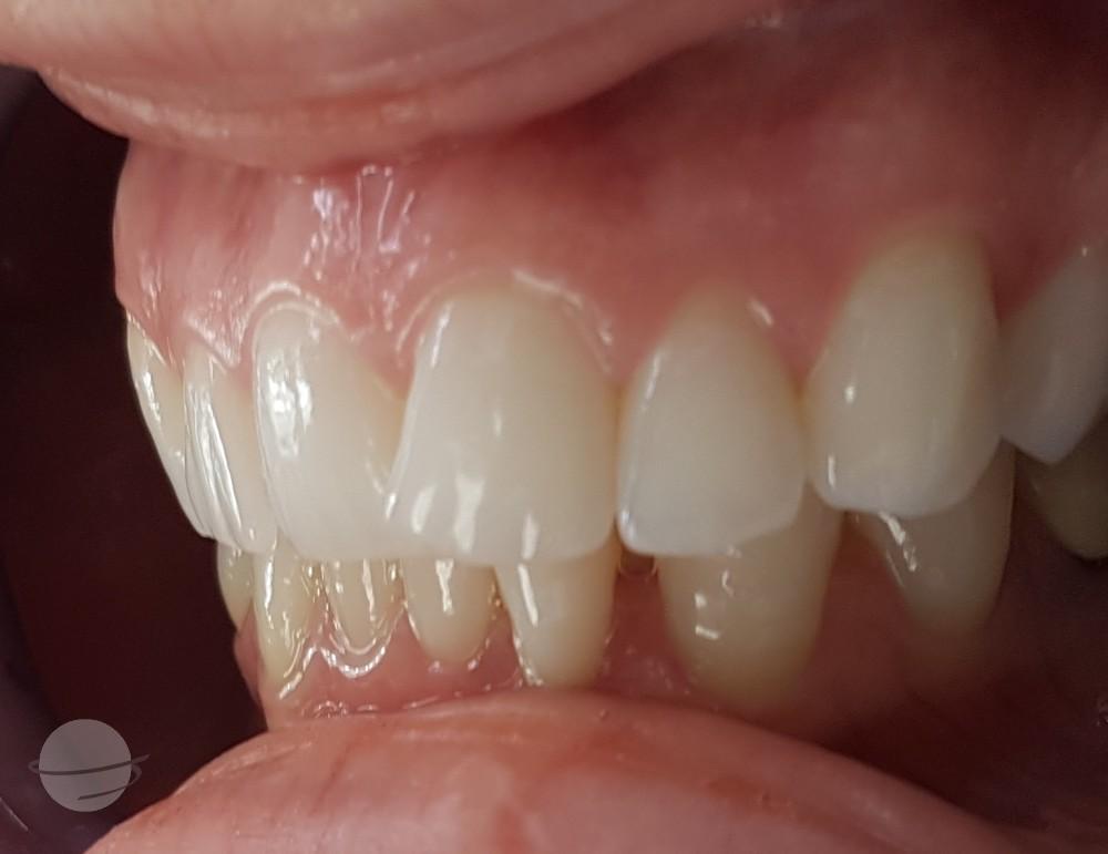 Before Veneers / Avant facettes