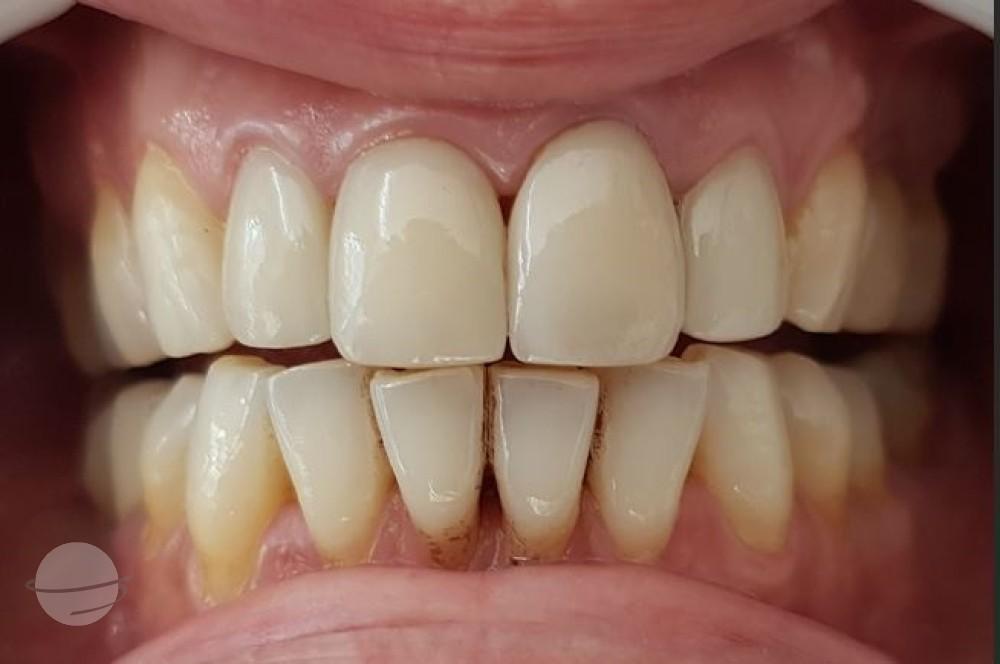 Before Veneers / Avant facettes