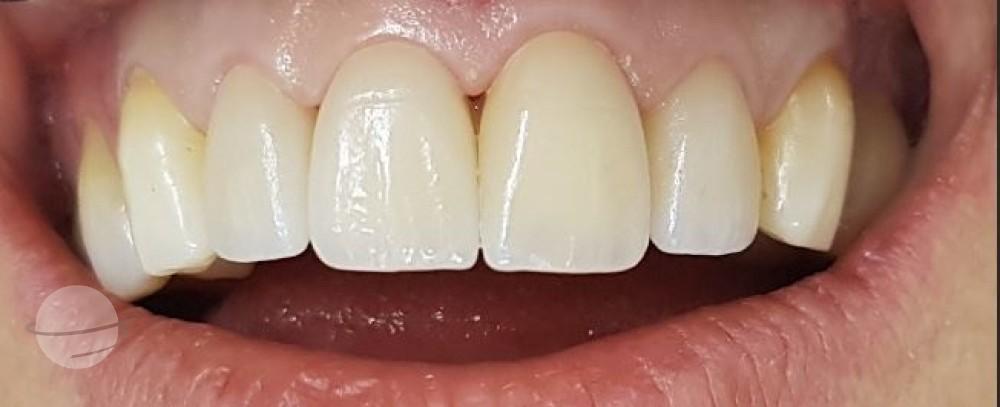 After Veneers / Après facettes