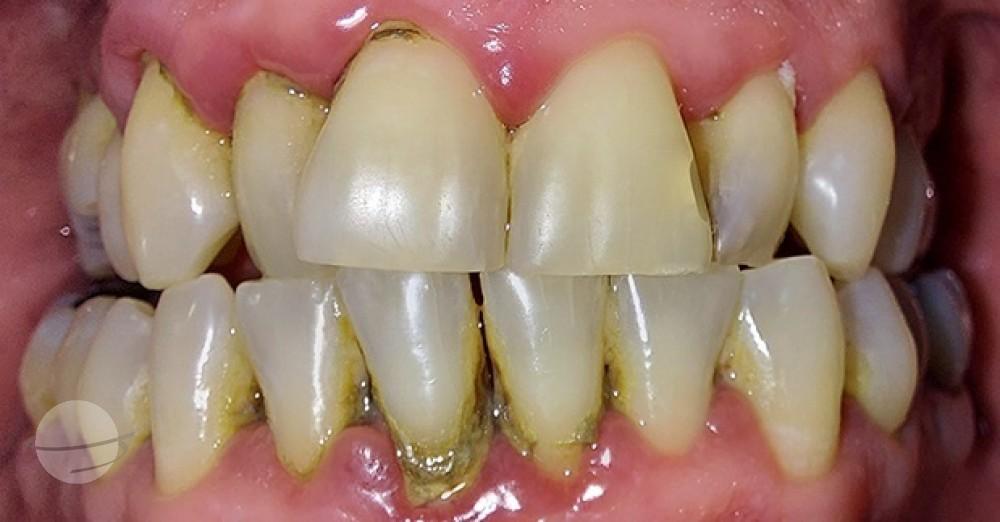 Before Veneers / Avant facettes