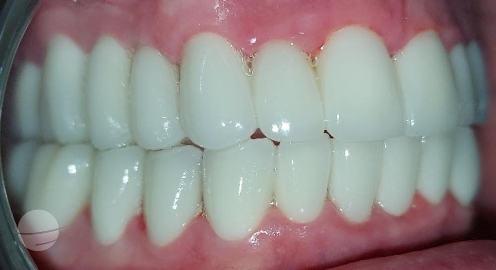 Risultato prima e dopo per Faccette Emax — Dentglow