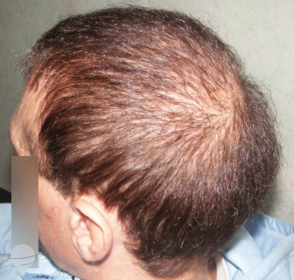 Before and after result for BHT Body Hair Transplant — Dr A's clinic - hair Transplant clinic